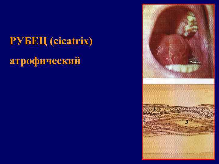 РУБЕЦ (cicatrix) атрофический 
