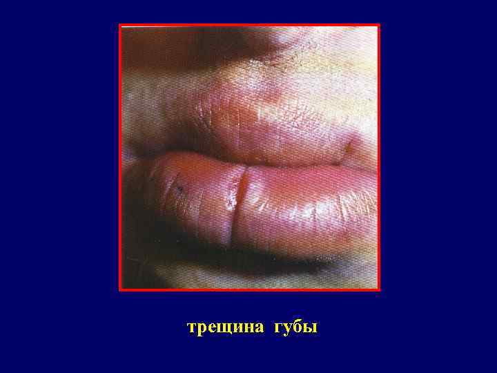 трещина губы 