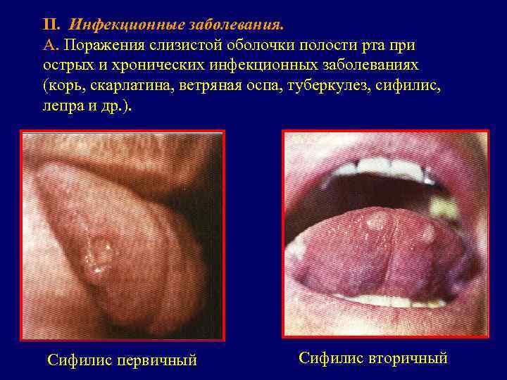 II. Инфекционные заболевания. А. Поражения слизистой оболочки полости рта при острых и хронических инфекционных