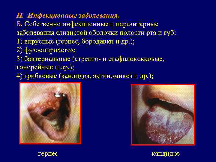 II. Инфекционные заболевания. Б. Собственно инфекционные и паразитарные заболевания слизистой оболочки полости рта и