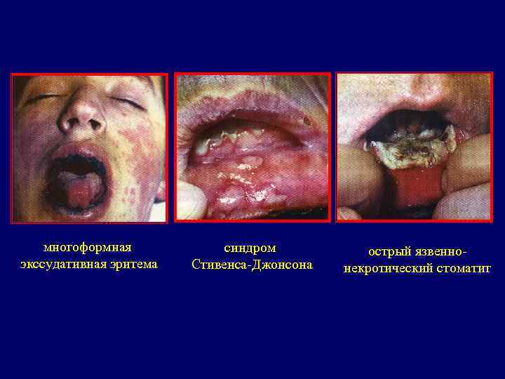   многоформная   синдром  острый язвенно- экссудативная эритема  Стивенса-Джонсона 
