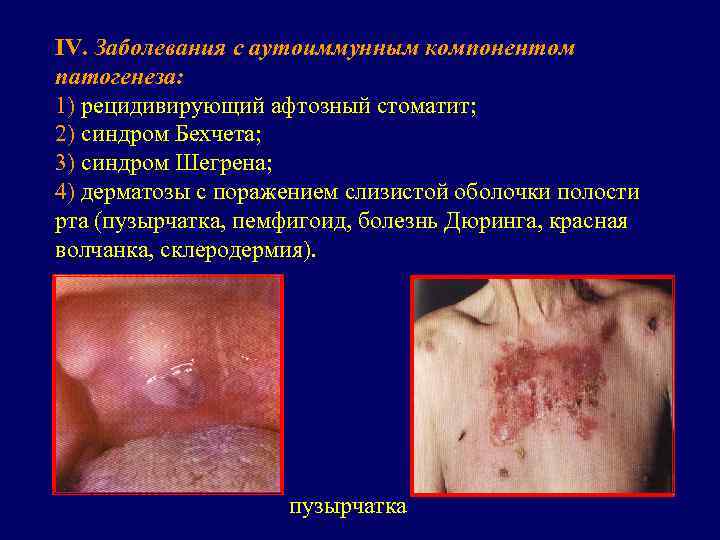IV. Заболевания с аутоиммунным компонентом патогенеза: 1) рецидивирующий афтозный стоматит; 2) синдром Бехчета; 3)