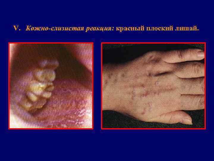 V. Кожно слизистая реакция: красный плоский лишай. 