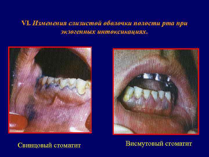  VI. Изменения слизистой оболочки полости рта при   экзогенных интоксикациях. Свинцовый стоматит
