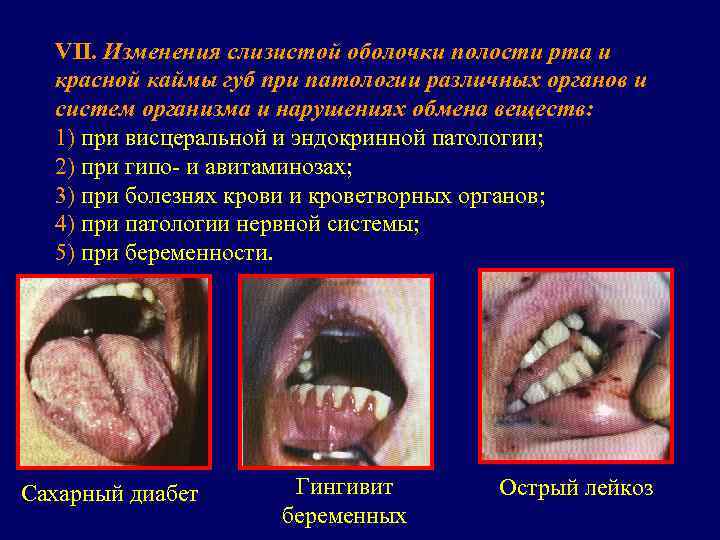  VII. Изменения слизистой оболочки полости рта и  красной каймы губ при патологии