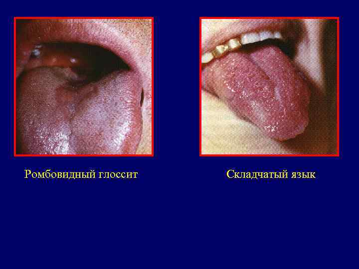 Ромбовидный глоссит  Складчатый язык 