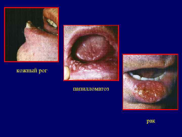 кожный рог    папилломатоз       рак 