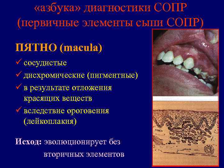   «азбука» диагностики СОПР (первичные элементы сыпи СОПР) ПЯТНО (macula) ü сосудистые ü