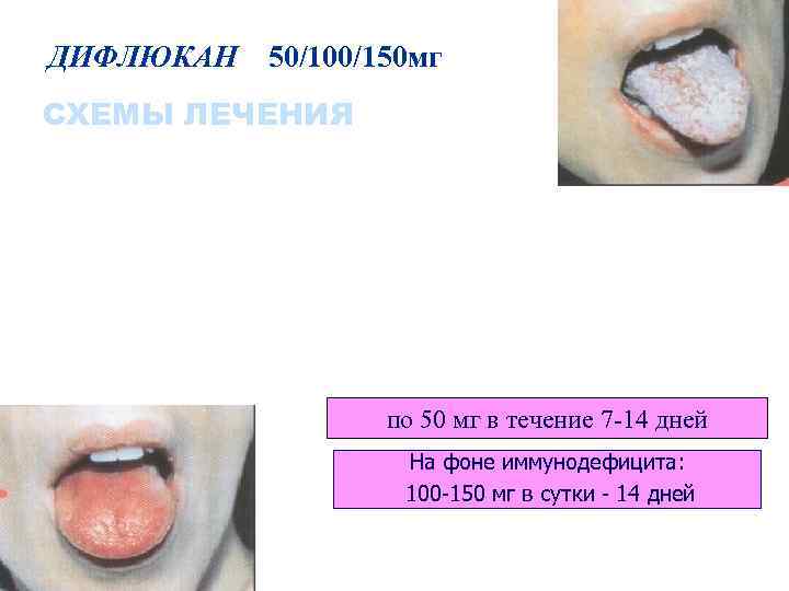 ДИФЛЮКАН  50/100/150 мг СХЕМЫ ЛЕЧЕНИЯ Отомикозы Кандидозные фарингиты, хейлиты Хронические тонзиллиты грибковой этиологии