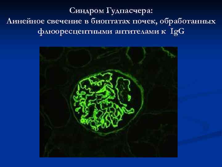    Синдром Гудпасчера: Линейное свечение в биоптатах почек, обработанных  флюоресцентными антителами