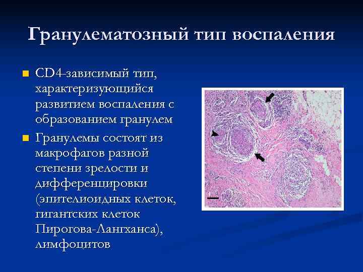 Гранулематозный тип воспаления n  CD 4 -зависимый тип, характеризующийся развитием воспаления с образованием