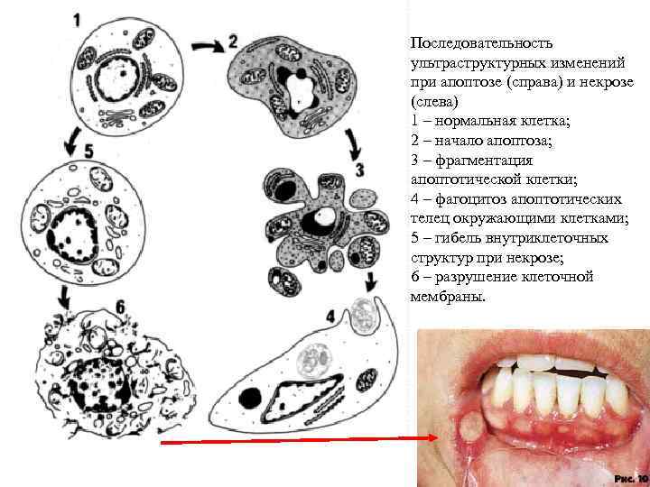 Последовательность ультраструктурных изменений при апоптозе (справа) и некрозе (слева) 1 – нормальная клетка; 2 Последовательность ультраструктурных изменений при апоптозе (справа) и некрозе (слева) 1 – нормальная клетка; 2
