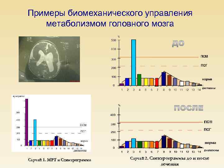Примеры биомеханического управления метаболизмом головного мозга Случай 1. МРТ и Спектрограмма Случай 2. Спектрограммы