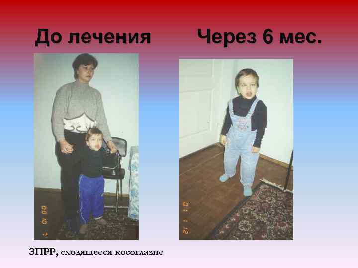 До лечения ЗПРР, сходящееся косоглазие Через 6 мес. 