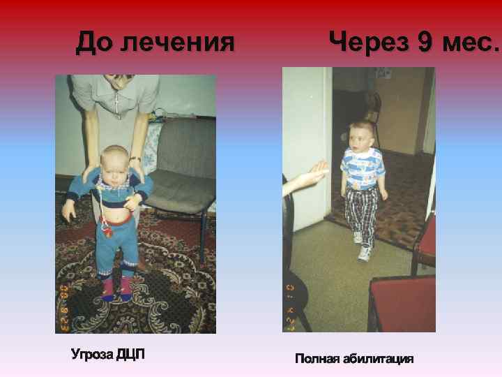 До лечения Угроза ДЦП Через 9 мес. Полная абилитация 