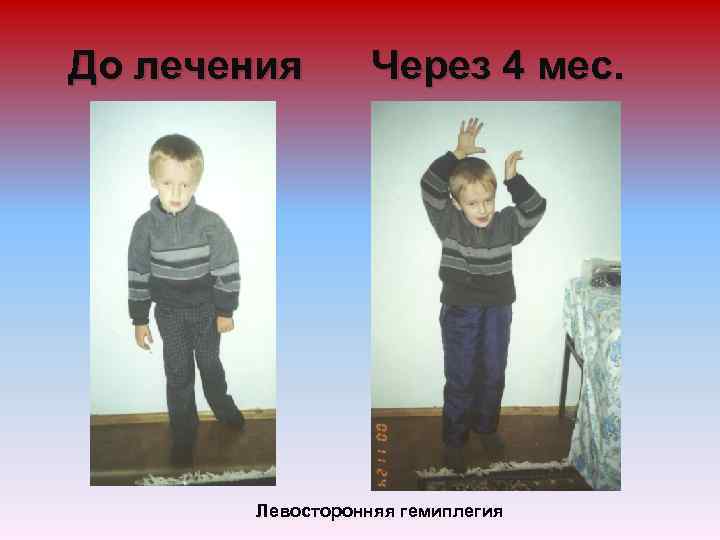 До лечения Через 4 мес. Левосторонняя гемиплегия 