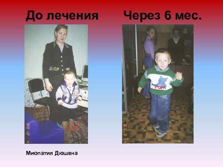 До лечения Миопатия Дюшена Через 6 мес. 