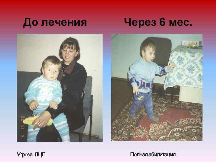 До лечения Угроза ДЦП Через 6 мес. Полная абилитация 