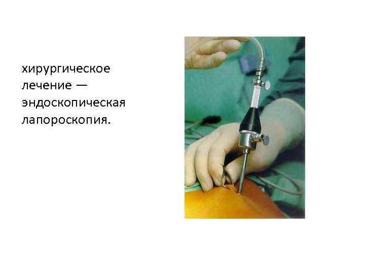 хирургическое лечение — эндоскопическая лапороскопия. 
