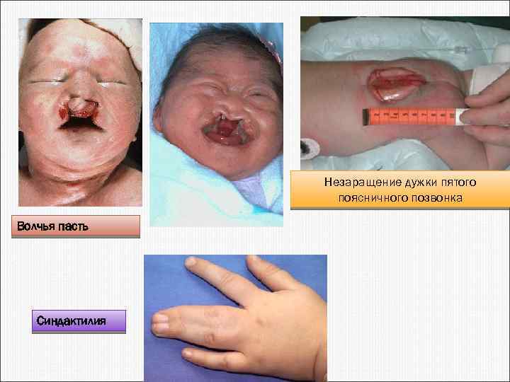 Незаращение дужки пятого поясничного позвонка Волчья пасть Синдактилия 