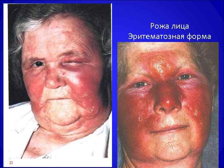  Рожа лица Эритематозная форма 