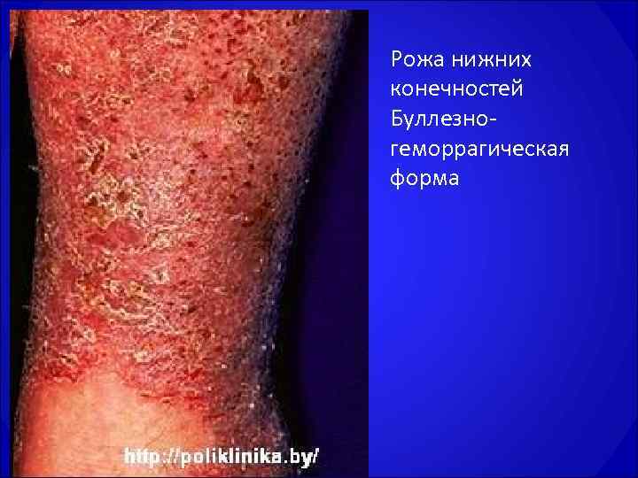 Рожа нижних конечностей Буллезно геморрагическая форма 