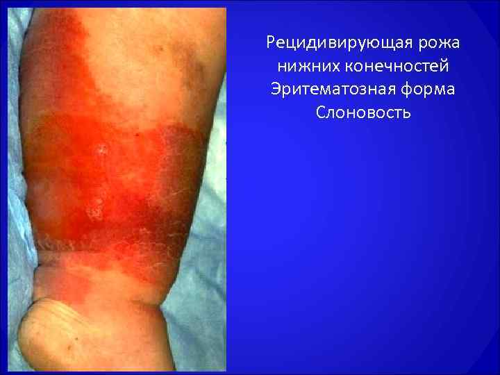 Рецидивирующая рожа  нижних конечностей Эритематозная форма  Слоновость  