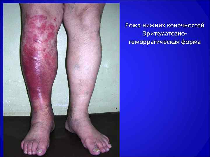 Рожа нижних конечностей Эритематозно  геморрагическая форма 