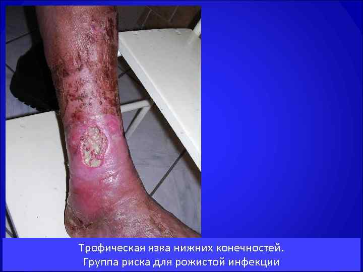 Трофическая язва нижних конечностей.  Группа риска для рожистой инфекции 