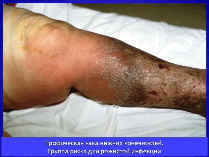 Трофическая язва нижних конечностей.  Группа риска для рожистой инфекции 