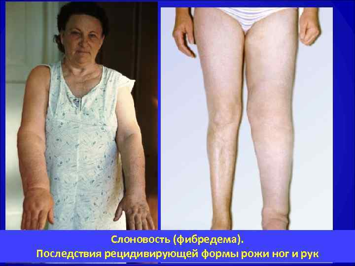    Слоновость (фибредема). Последствия рецидивирующей формы рожи ног и рук 