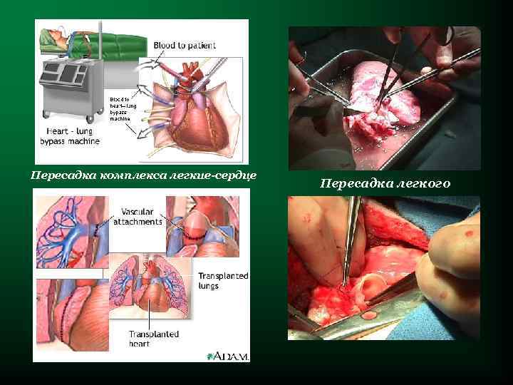 Пересадка комплекса легкие-сердце       Пересадка легкого 