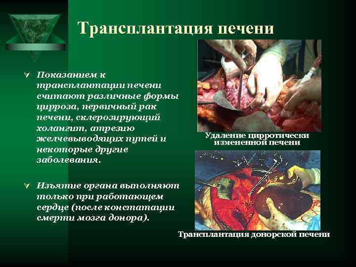    Трансплантация печени Ú Показанием к  трансплантации печени  считают различные