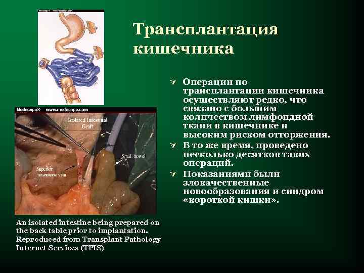       Трансплантация      кишечника 