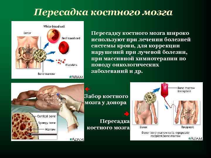 Пересадка костного мозга  Пересадку костного мозга широко  используют при лечении болезней 