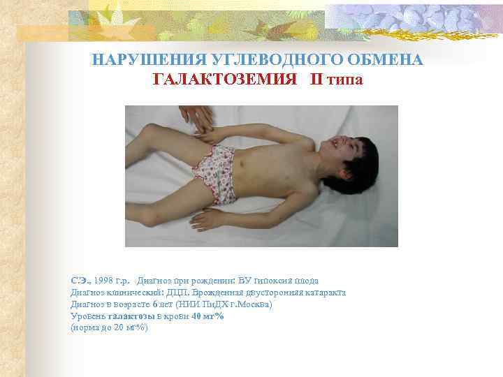   НАРУШЕНИЯ УГЛЕВОДНОГО ОБМЕНА   ГАЛАКТОЗЕМИЯ II типа С. Э. , 1998