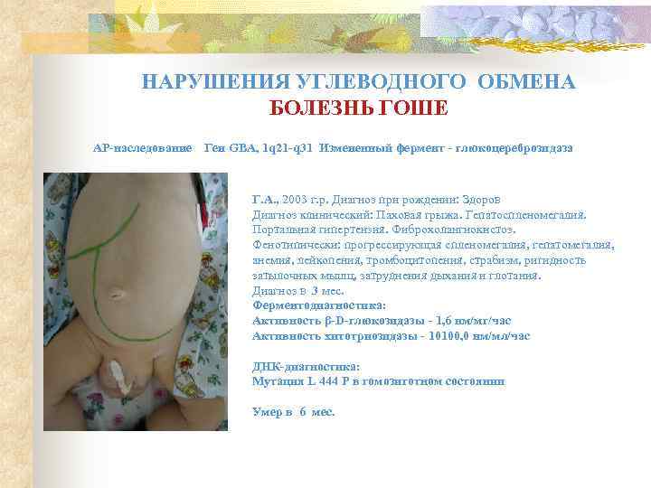   НАРУШЕНИЯ УГЛЕВОДНОГО ОБМЕНА    БОЛЕЗНЬ ГОШЕ АР-наследование  Ген GBA,
