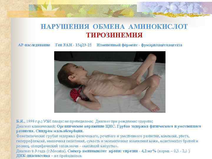   НАРУШЕНИЯ ОБМЕНА АМИНОКИСЛОТ     ТИРОЗИНЕМИЯ АР-наследование Ген FAH -