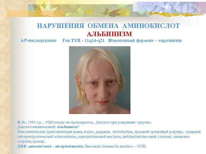    НАРУШЕНИЯ ОБМЕНА АМИНОКИСЛОТ     АЛЬБИНИЗМ АР-наследование  Ген