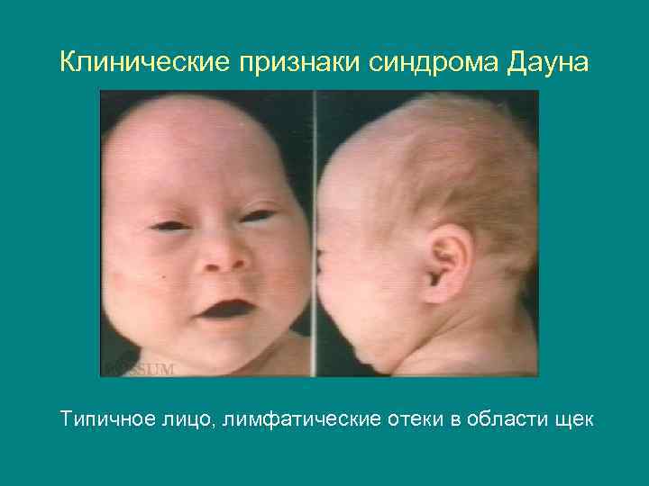 Клинические признаки синдрома Дауна Типичное лицо, лимфатические отеки в области щек 