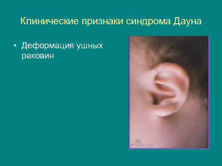 Клинические признаки синдрома Дауна • Деформация ушных раковин 