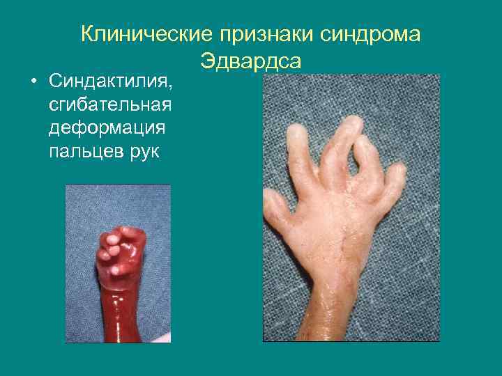 Клинические признаки синдрома Эдвардса • Синдактилия, сгибательная деформация пальцев рук 