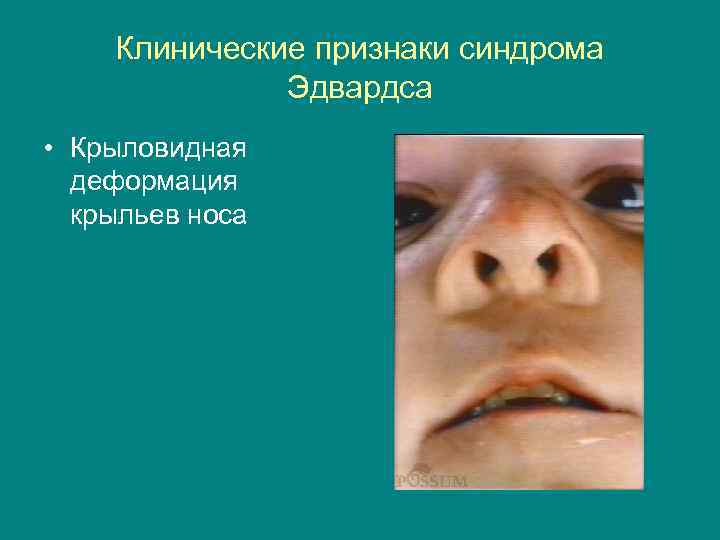 Клинические признаки синдрома Эдвардса • Крыловидная деформация крыльев носа 