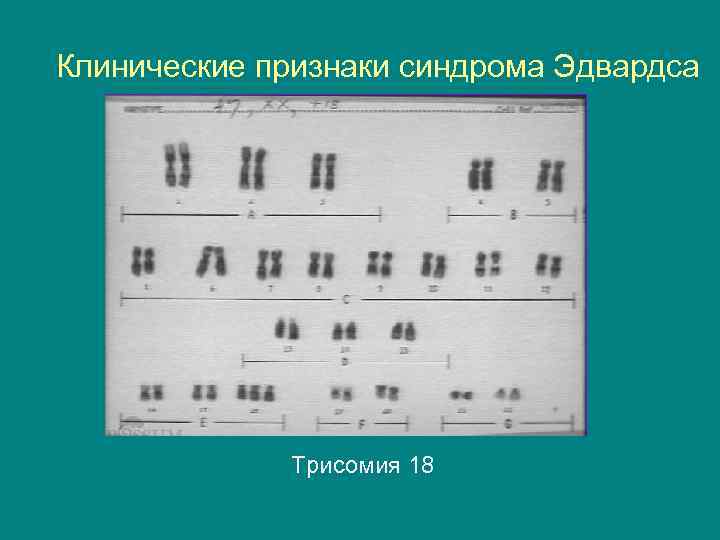 Клинические признаки синдрома Эдвардса Трисомия 18 