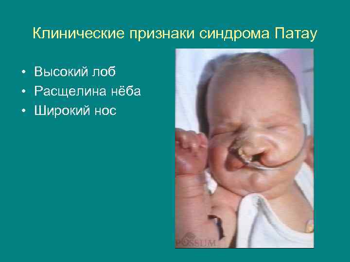 Клинические признаки синдрома Патау • Высокий лоб • Расщелина нёба • Широкий нос 
