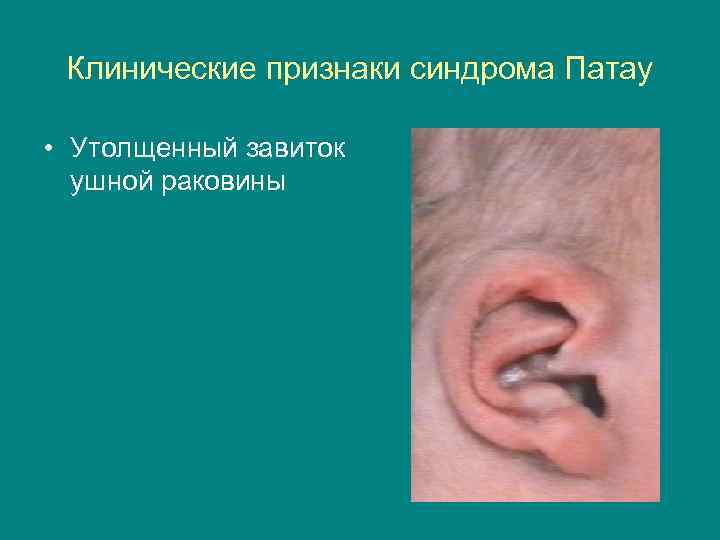 Клинические признаки синдрома Патау • Утолщенный завиток ушной раковины 
