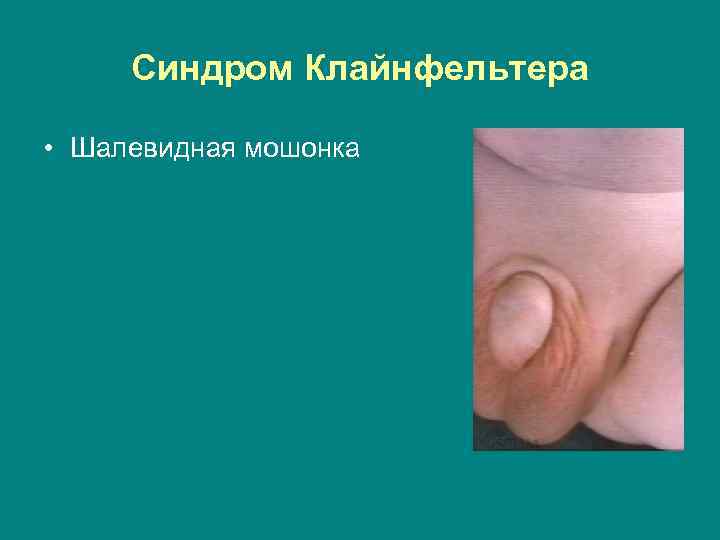 Синдром Клайнфельтера • Шалевидная мошонка 