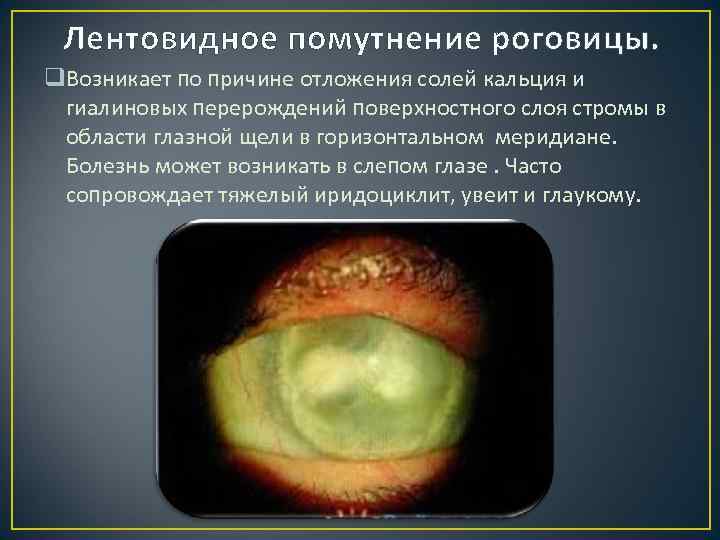Лентовидное помутнение роговицы. q. Возникает по причине отложения солей кальция и гиалиновых перерождений поверхностного