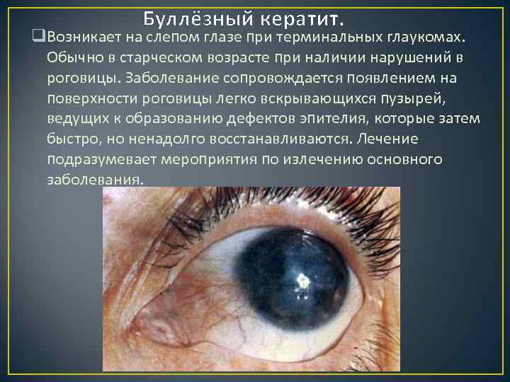 Буллёзный кератит. q. Возникает на слепом глазе при терминальных глаукомах. Обычно в старческом возрасте