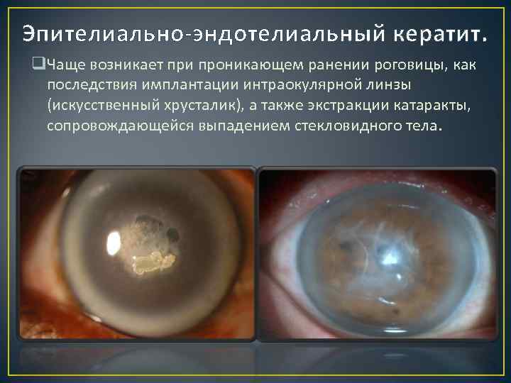 Эпителиально-эндотелиальный кератит. q. Чаще возникает при проникающем ранении роговицы, как последствия имплантации интраокулярной линзы